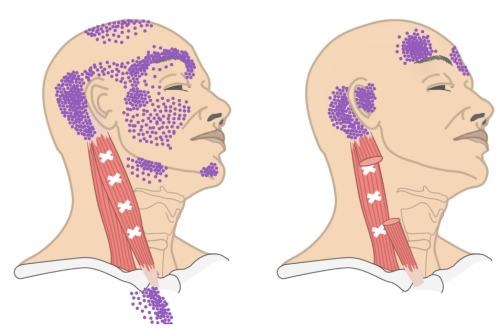 cervicogene hoofdpijn